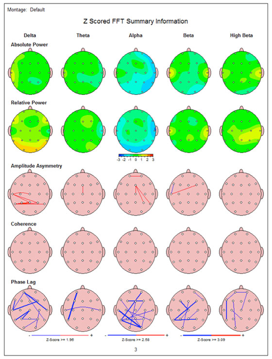 Example of QEEG Report